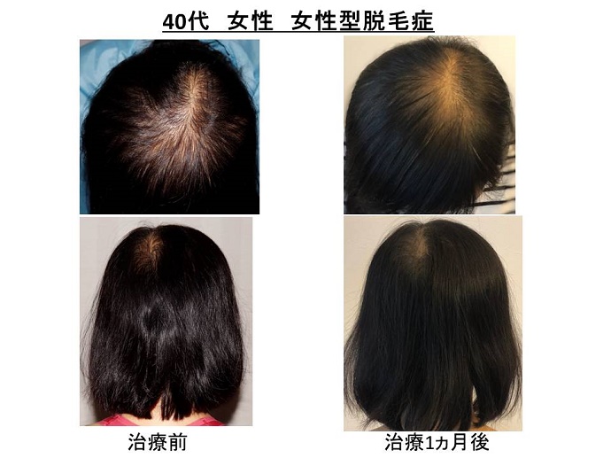 円形脱毛症　病院